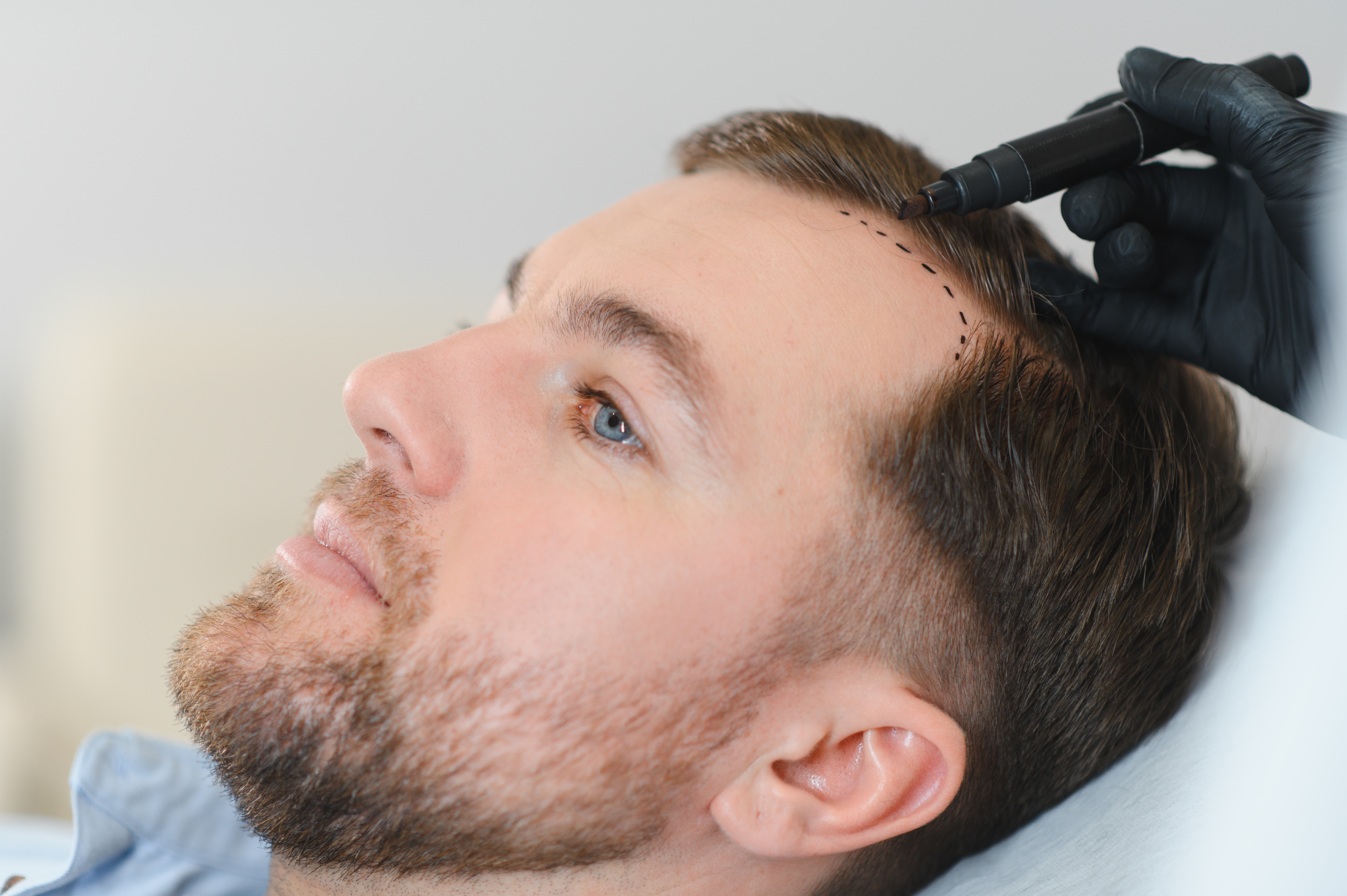 Hairline Restoration SMP